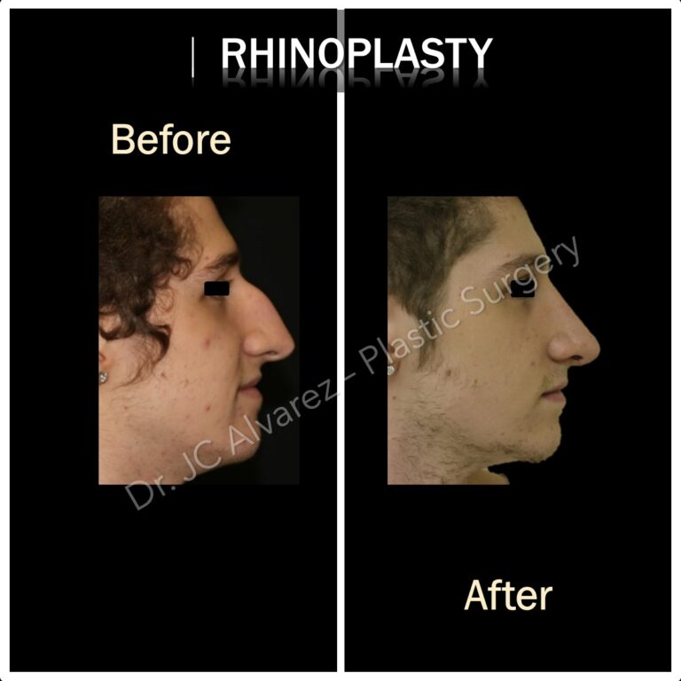 Breathing Better After Rhinoplasty: A Patient’s Tale