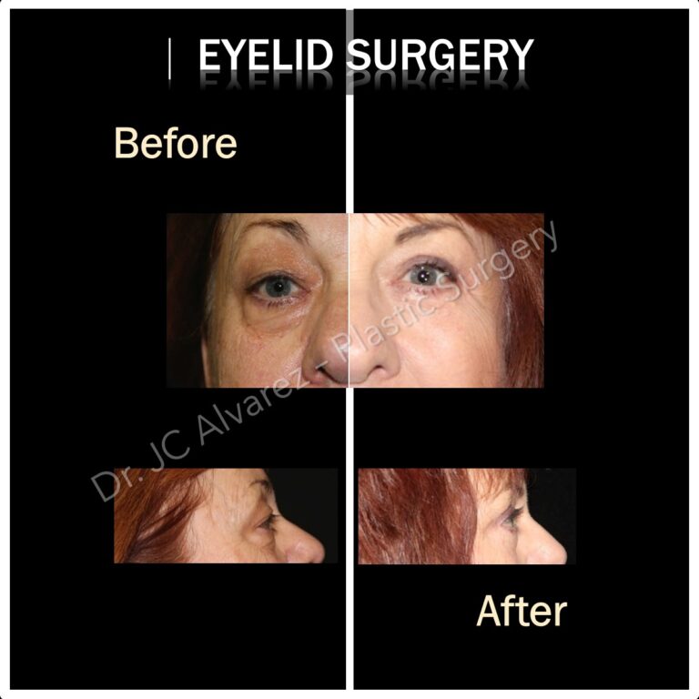 From Tired to Refreshed: My Eyelid Surgery Story